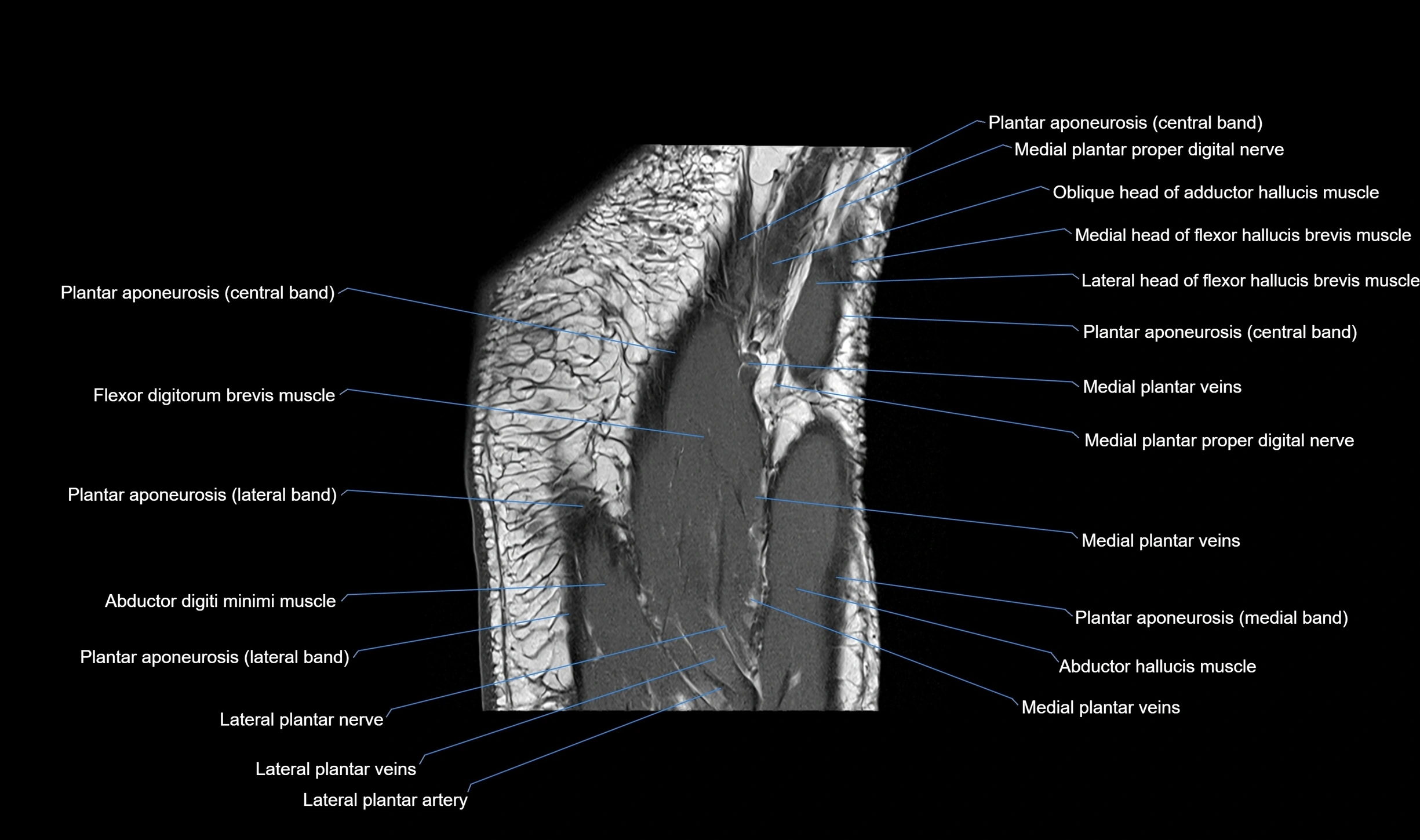 MRI mid foot coronal ligaments cross sectional anatomy 3T  radiology  image-img-00001-00036.webp